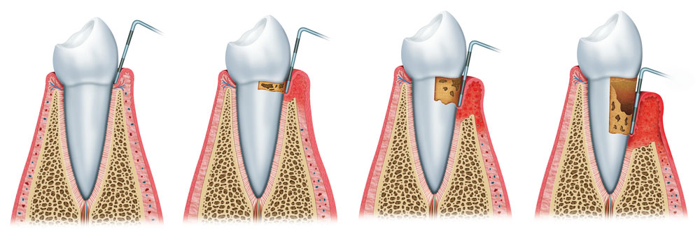 Periodontal Disease