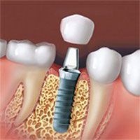 Tooth Implant